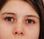 Dark Circles