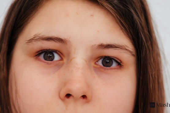 Dark Circles