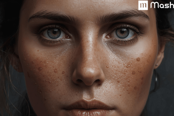 Potato For Dark Spots And Pigmentation 69 Dark Spots min