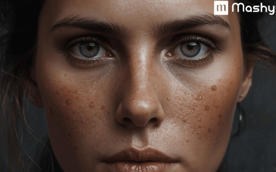 Potato For Dark Spots And Pigmentation 12 Dark Spots min